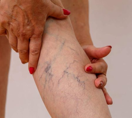 Cord or prominent varicose veins