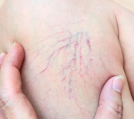 Spider-Veins-1
