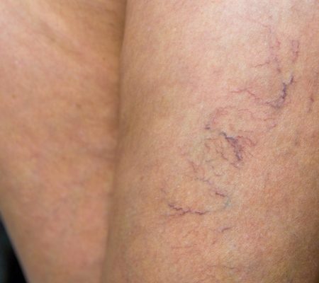 Spider-veins-1296X728-slide2