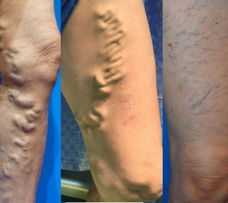 Varicose veins of the lower extremities