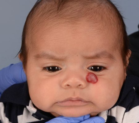 vascular-anomaly-hemangioma