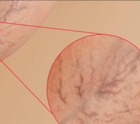 واریس لگنی یا سندرم احتقان لگن